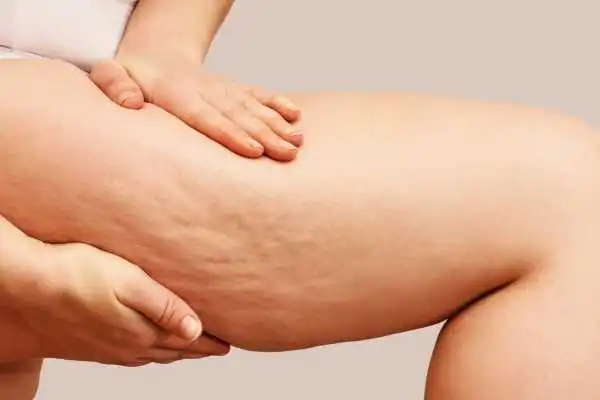 Image of woman showing leg with cellulite Clifton