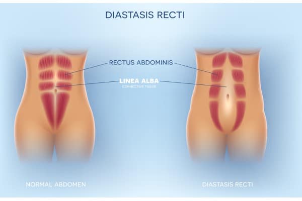 What Non-Surgical Options Are Available for Diastasis Recti Clifton?