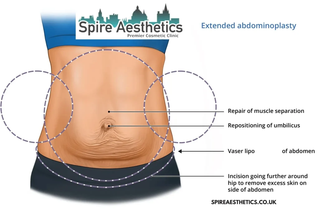 Understanding Loose Skin After Gastric Band Clifton Surgery and HIFU Treatment