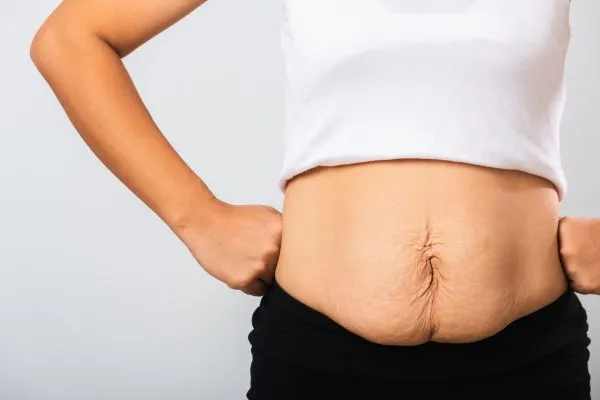 Image of a woman's stomach after weight loss with sagging skin following a gastric band Clifton